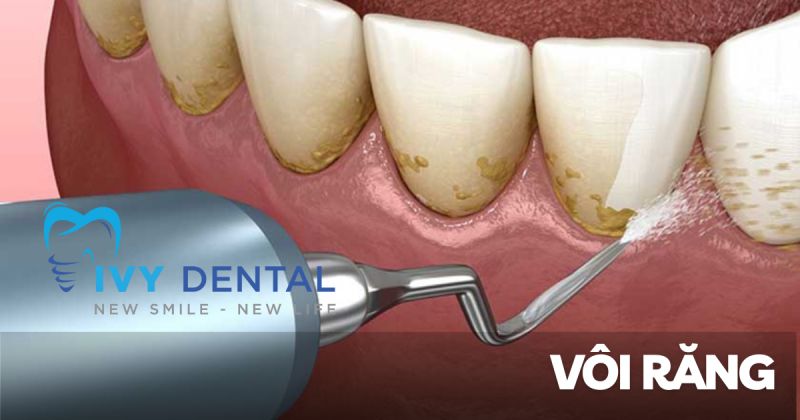 Vôi răng Nguyên nhân, triệu chứng và cách điều trị hiệu quả tại Nha khoa Ivy – Bình Thạnh
