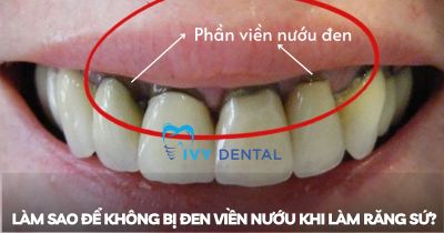 Răng Sứ | Làm sao để không bị đen viền nướu khi làm răng sứ? | Nha Khoa Ivy – Bình Thạnh