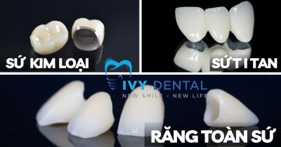 Răng Sứ | Tìm Hiểu Các Loại Răng Sứ Phổ Biến Tại Nha Khoa Ivy – Nha Khoa Uy Tín Quận Bình Thạnh
