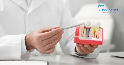 Cấy Ghép Implant Có Bị Đào Thải Không? | Nha Khoa Ivy – Bình Thạnh