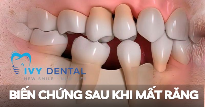 Biến chứng sau khi mất răng và giải pháp phục hồi tại Nha khoa Ivy – Bình Thạnh
