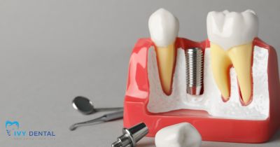 Các phương pháp phục hồi mất răng? Phương pháp nào tối ưu nhất? | Nha khoa Ivy – Bình Thạnh