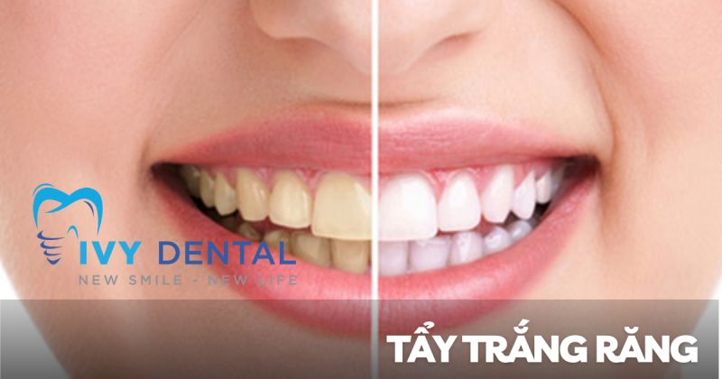 Tẩy trắng răng | Lựa chọn phương pháp phù hợp cho nụ cười tỏa sáng | Nha khoa Ivy – Bình Thạnh