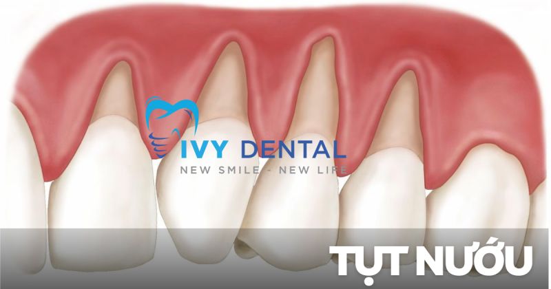 Tụt nướu: Nguyên nhân, triệu chứng và cách điều trị hiệu quả | Nha khoa Ivy – Bình Thạnh