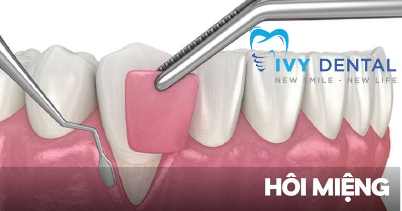 Ghép nướu Giải pháp phục hồi nụ cười tự tin tại Nha khoa Ivy – Bình Thạnh