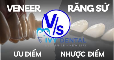 Ưu điểm & Nhược điểm của hai phương pháp thẩm mỹ phổ biến hiện nay: Răng Sứ và Mặt Dán Sứ (Veneer) | Nha khoa Ivy – Bình Thạnh