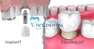 Implant Hay Cầu Răng Sứ: Lựa Chọn Nào Phù Hợp Với Bạn? | Nha Khoa Ivy – Bình Thạnh