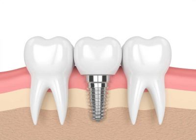Cấu tạo của implant