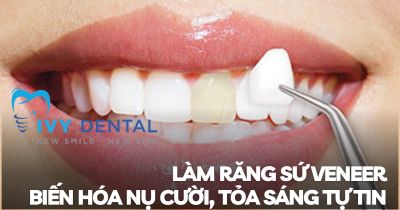 Làm răng sứ Veneer Biến hóa nụ cười, tỏa sáng tự tin | Nha khoa Ivy – Bình Thạnh