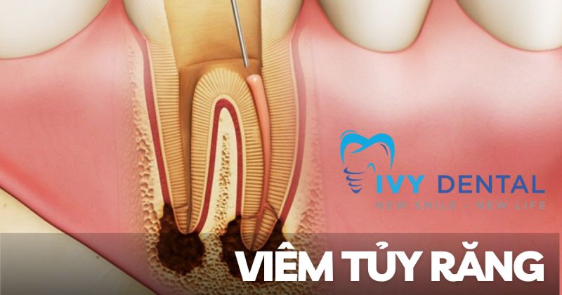 Viêm tủy răng: Nguyên nhân, triệu chứng và cách điều trị hiệu quả | Nha khoa Ivy – Bình Thạnh
