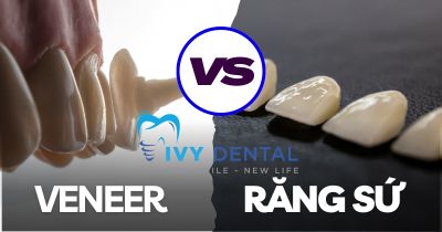 Mặt dán sứ Veneer và bọc răng sứ: Lựa chọn nào tối ưu hơn? | Nha khoa Ivy – Bình Thạnh