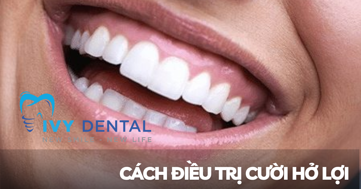 nha khoa ivy - Cười hở lợi Nguyên nhân triệu chứng và cách điều trị hiệu quả