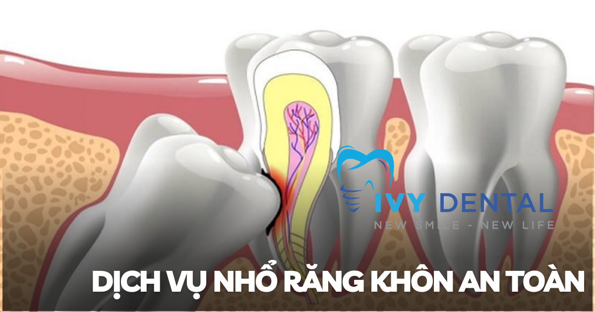 nha khoa ivy - Dịch Vụ Nhổ Răng Khôn An Toàn Tại Nha Khoa Ivy Bình Thạnh TP. Hồ Chí Minh
