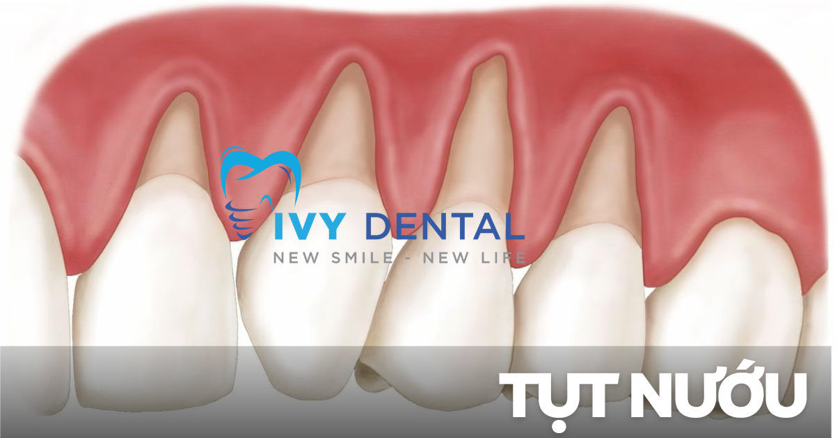 Tụt nướu Nguyên nhân triệu chứng và cách điều trị hiệu quả Nha khoa Ivy - Bình Thạnh