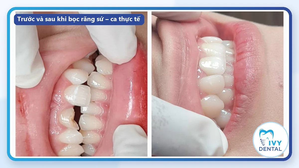 Ca thực tế trường hợp nên bọc răng sứ: răng sứt mẻ, lệch lạc trước và sau điều trị