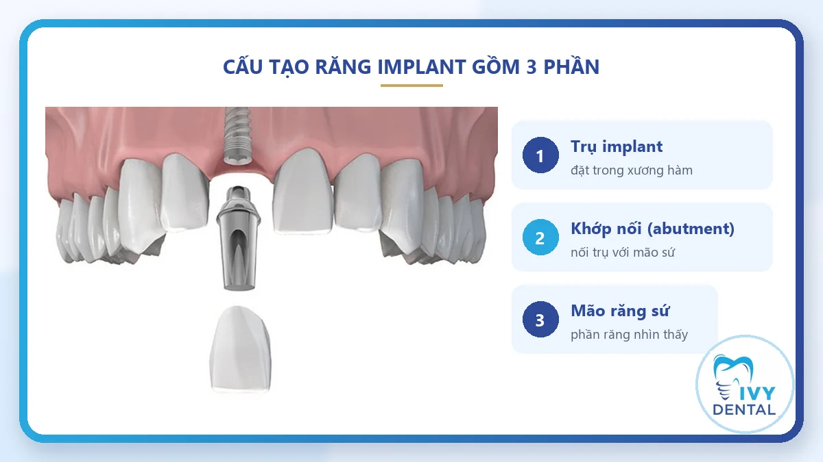 Cấu tạo implant nha khoa gồm trụ titanium, khớp nối abutment và mão răng sứ