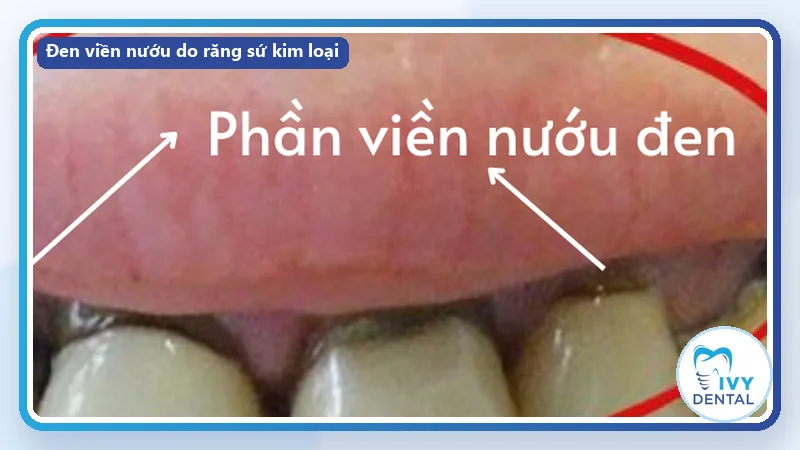 Đen viền nướu – biến chứng khi bọc răng sứ không đúng cách