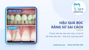 Hậu quả bọc răng sứ sai cách: dấu hiệu và cách xử lý