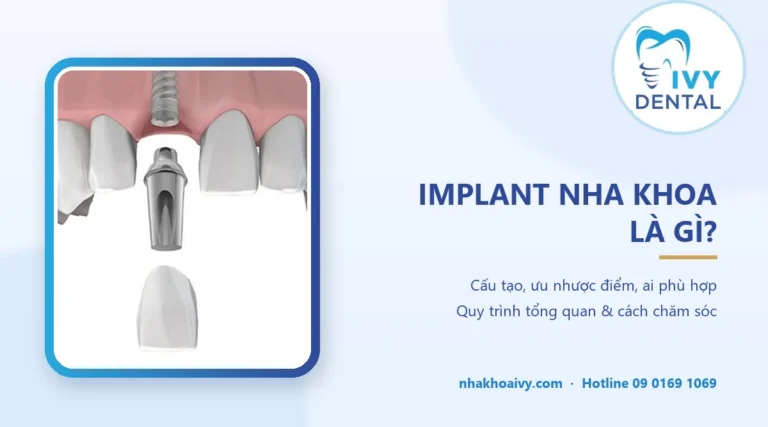 Implant nha khoa là gì? Cấu tạo, ưu nhược điểm, ai nên làm
