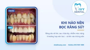 Khi nào nên bọc răng sứ? 6 trường hợp cần biết