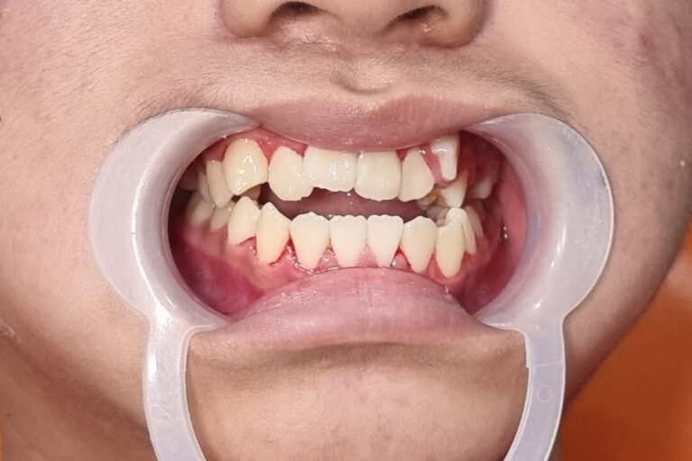 KHỚP CẮN HỞ KHÔNG CẮN ĐỨT THỨC ĂN