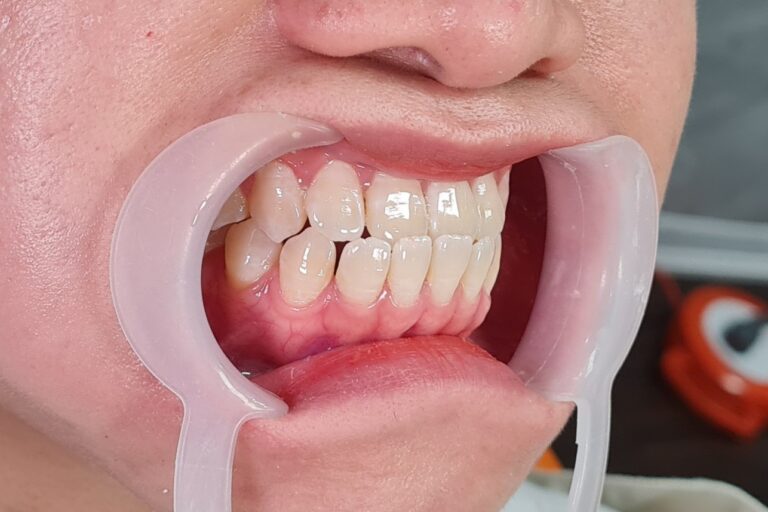 KHỚP CẮN NGƯỢC (RĂNG MÓM) DO RĂNG HAY DO XƯƠNG