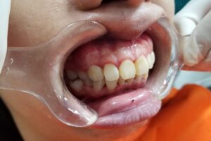 NHẬN BIẾT CÁC CẤP ĐỘ RĂNG HÔ VẨU