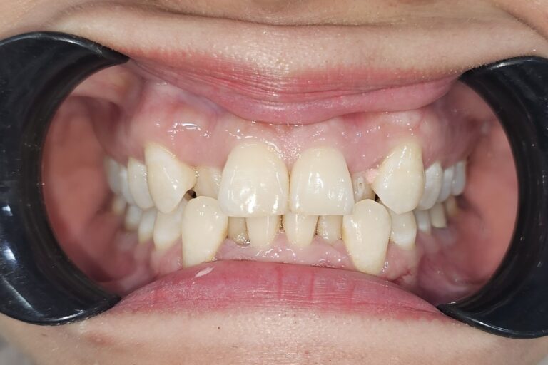 RĂNG KHẤP KHỂNH CHEN CHÚC VÀ NGUY CƠ SÂU RĂNG